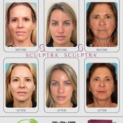 Yana Skin Care - See the Difference with Sculptra! Natural, gradual results that restore youthful volume.