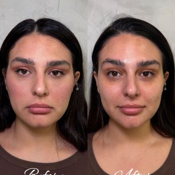 The Shene Skin - Before and after pictures of a Buccal massage treatment - Skin Care Near Me - Irvine, California The Shene Skin - Before and after pictures of a Buccal massage treatment - Skin Care Near Me - Irvine, California