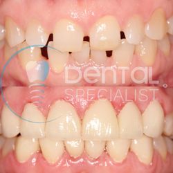 Dental Specialist - Porcelain emax- life-changing difference!