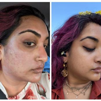 Skin Alchemy Collective - Immediately after vs morning after - Medical Spas Near Me - Wilton Manors, Florida Skin Alchemy Collective - Immediately after vs morning after - Medical Spas Near Me - Wilton Manors, Florida