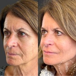 Body Tonic Aesthetics & Wellnesss - Sculptra + Neurotoxins by Iris Taylor