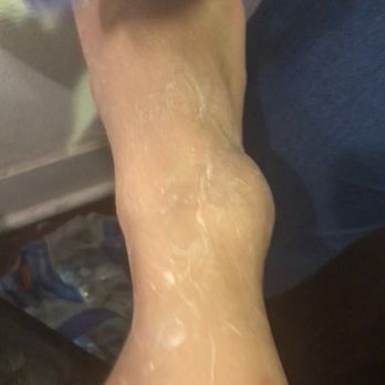 The Law Collective - Day after my accident. My ankle was really swollen. - Personal Injury Law Near Me - Los Angeles, California The Law Collective - Day after my accident. My ankle was really swollen. - Personal Injury Law Near Me - Los Angeles, California