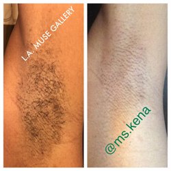 LA Muse Gallery - Underarm hair removal before and after