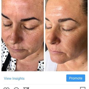 Glow Skin and Body Spa - Pigmentation treatment after chemical peels - Skin Care Near Me - Modesto, California Glow Skin and Body Spa - Pigmentation treatment after chemical peels - Skin Care Near Me - Modesto, California