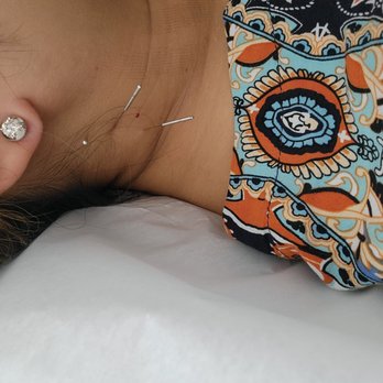 Northridge Acupuncture - Amazing feeling every after the session. - Acupuncture Near Me - Reseda, California Northridge Acupuncture - Amazing feeling every after the session. - Acupuncture Near Me - Reseda, California