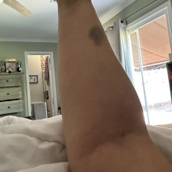 USC Arcadia Hospital - Bruises from multiple iv insertion attempts. - Hospitals Near Me - Arcadia, California USC Arcadia Hospital - Bruises from multiple iv insertion attempts. - Hospitals Near Me - Arcadia, California