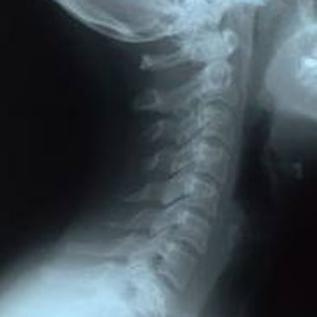 Kemner Chiropractic - X Ray Neck - Physical Therapy Near Me - Stuart, Florida Kemner Chiropractic - X Ray Neck - Physical Therapy Near Me - Stuart, Florida