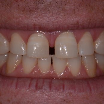 Michael A. Shustak, DMD - Sample 1: Before treatment photograph  (see our website for more photographs) - General Dentistry Near Me - Worcester, Massachusetts Michael A. Shustak, DMD - Sample 1: Before treatment photograph  (see our website for more photographs) - General Dentistry Near Me - Worcester, Massachusetts