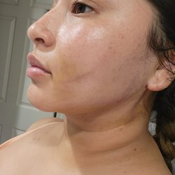 Anne's Curves - After my first massage with Anne. I felt so much relief after my visit. 3 days post op.