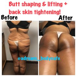 Adream Body Cafe - We can enhance and lift your buttocks and shape them into that look you may desire. Contact us today to learn more & book your consultation!