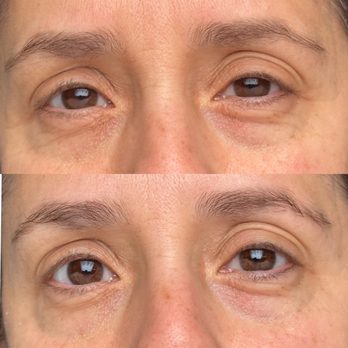 Fibroblast Facelift - Before and after - Skin Care Near Me - Pasadena, California Fibroblast Facelift - Before and after - Skin Care Near Me - Pasadena, California