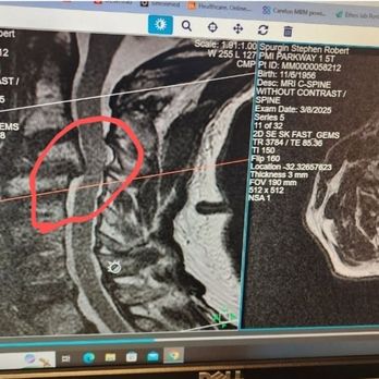 Daniel D Lee, MD - Severe pinch at C-5 - Orthopedists Near Me - Las Vegas, Nevada
