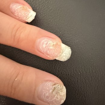 Vinci Nails - Fungus on nails - Nail Salons Near Me - Des Plaines, Illinois