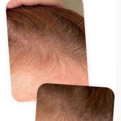 HairVive Trichology Clinic - Before/after