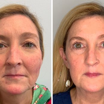 Glo MedSpa - An amazing transformation with Radiesse!! - Skin Care Near Me - Wilmington, North Carolina Glo MedSpa - An amazing transformation with Radiesse!! - Skin Care Near Me - Wilmington, North Carolina