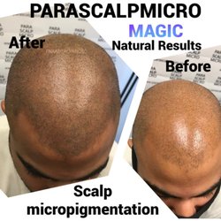 Parascalpmicro - Buzz Cut to Male Pattern Baldness, Hair Density Scalp Micropigmentation,  Nano Hair Follicle Tattoo. New York City School & Training