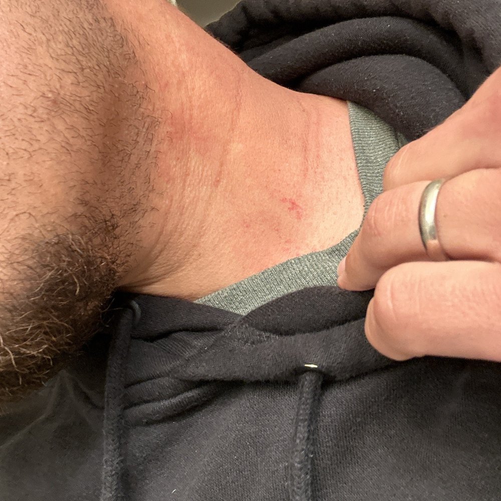 Velocity Paintball Park - Rash from rental gear. - Paintball Near Me - Ramona, California Velocity Paintball Park - Rash from rental gear. - Paintball Near Me - Ramona, California