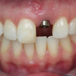 Steven M Streelman, DDS - Before photo of an implant case.  The missing tooth and the adjacent tooth were restored with  porcelain crowns.
