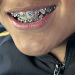 Miao Orthodontics & Angela Chow Children's Dentist - Day off when the braces on placed