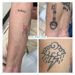 Bye Bye Ink - Fully gone after 6 sessions