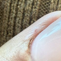 The Nails Center - Wound