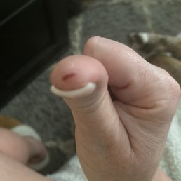Two days later after a tetanus and antibiotic Two days later after a tetanus and antibiotic