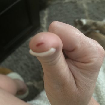 May Nails & Spa - Two days later after a tetanus and antibiotic - Nail Salons Near Me - Yukon, Oklahoma May Nails & Spa - Two days later after a tetanus and antibiotic - Nail Salons Near Me - Yukon, Oklahoma