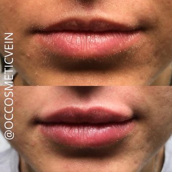 OC Cosmetic and Vein Center - 1/2 Syringe of Restylane Kysse - Medical Spas Near Me - Brea, California OC Cosmetic and Vein Center - 1/2 Syringe of Restylane Kysse - Medical Spas Near Me - Brea, California
