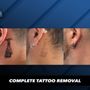 Inkless Tattoo Removal
