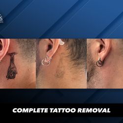 Inkless Tattoo Removal