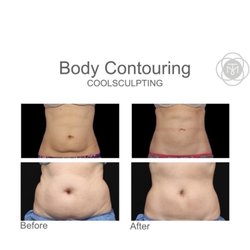 SkinLab NYC - Coolsculpting For Abs