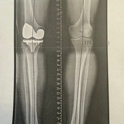James Crutcher Jr, MD - After surgery.  Look how straight I can stand!