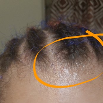 Towne Square Salons - A proper braided scalp should not be raised/lumpy that way nor   have that many inflamed bumps for being in for only a FEW hours. - Hair Salons Near Me - Plano, Texas