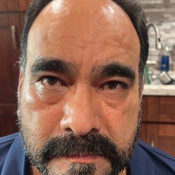 Neopel - Antes - Hair Loss Centers Near Me - Tijuana, BCN