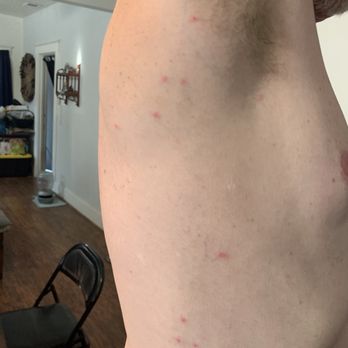 Best Western Plus Island Palms Hotel & Marina - Bug bites I received from sleeping in the bed - San Diego, CA