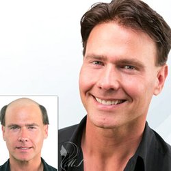 Celebrity Hair - hair replacement system Before / after
