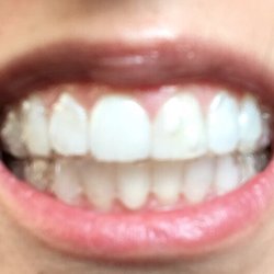Edward S Boim, DDS - Toward the end of my Invisalign treatment with the aligners on.