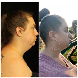 Nashville Cosmetic Surgery: Don Griffin, MD - My chin/neck view pre-op and then 3 months post-op.