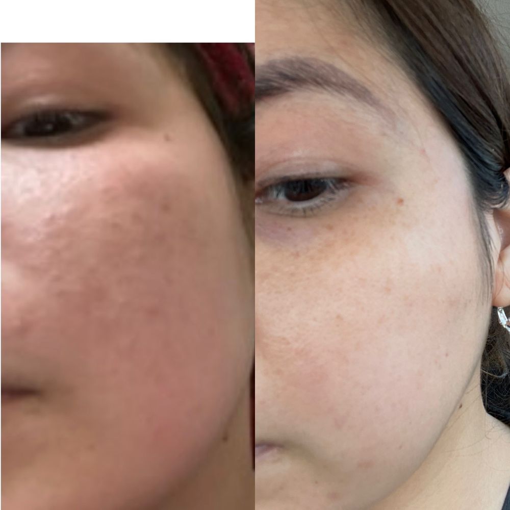 The spirolactone helped me so much it took 3 1/2 to get to the pic on the left but I'm so glad I stuck to it The spirolactone helped me so much it took 3 1/2 to get to the pic on the left but I'm so glad I stuck to it