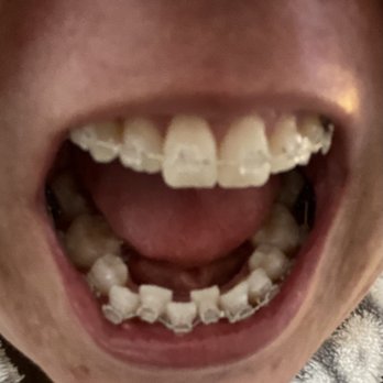 Jaymie Coria, DDS - Day after braces were put on - General Dentistry Near Me - Placentia, California