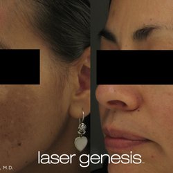 Atlanta Laser Lofts - Laser of Melasma & Sun damage, sun spots , freckles, brown spots