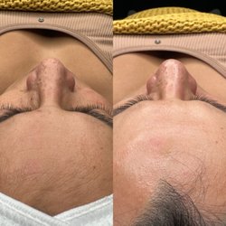 House of Esthetix - Hydrafacial
