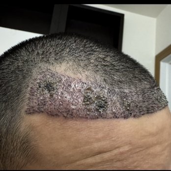 Care4Hair - Hair Loss Centers Near Me - Miami, Florida Care4Hair - Hair Loss Centers Near Me - Miami, Florida