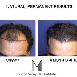 Silicon Valley Hair Institute - natural aesthetic hairlines