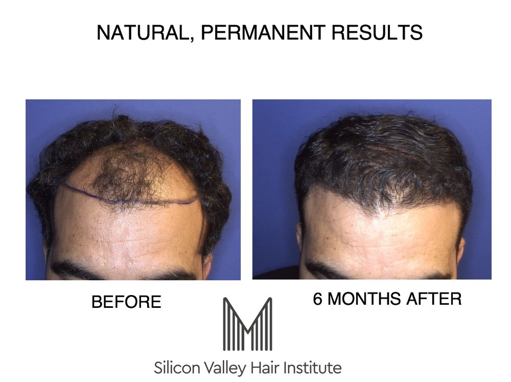 Silicon Valley Hair Institute — hair transplant clinic in