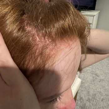 Chromatique Salon - Chemical Burn spots from color - Hair Extensions Near Me - Bellevue, Washington