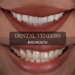 Omega Dental Specialists - Porcelain veneers for a bright, white, natural-looking smile. Cosmetic dentistry at Omega Dental Specialists in Midtown Houston.