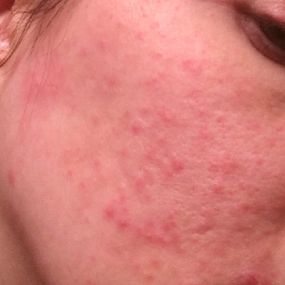 Cara Bella Boutique Spa - red, bumpy, irritated and painful bumps all over my face- none of which I have ever had before. And it wasn't caused by an allergic reaction - Waxing Near Me - Issaquah, Washington Cara Bella Boutique Spa - red, bumpy, irritated and painful bumps all over my face- none of which I have ever had before. And it wasn't caused by an allergic reaction - Waxing Near Me - Issaquah, Washington