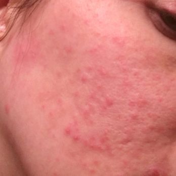Cara Bella Boutique Spa - red, bumpy, irritated and painful bumps all over my face- none of which I have ever had before. And it wasn't caused by an allergic reaction - Waxing Near Me - Issaquah, Washington Cara Bella Boutique Spa - red, bumpy, irritated and painful bumps all over my face- none of which I have ever had before. And it wasn't caused by an allergic reaction - Waxing Near Me - Issaquah, Washington