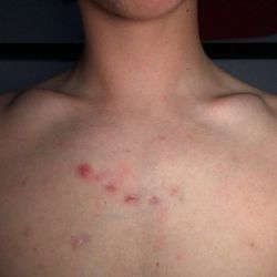 Skin and Cancer Associates - Day 120 (4 months) on Acutane with Dr. Studnik at Weston Cosmetics & Dermatology